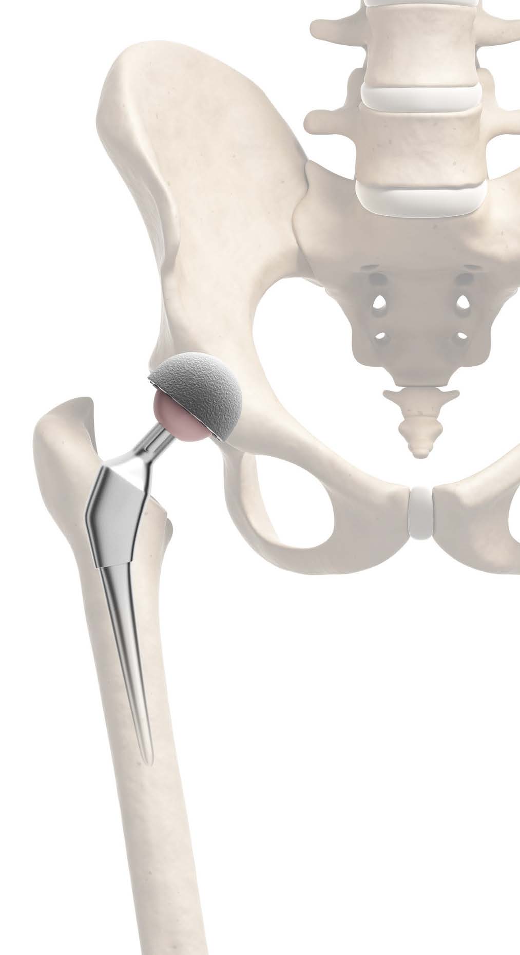 Кости медицинский. Stryker эндопротез. Коленный эндопротез DEPUY. Кейдж DEPUY Concord 11. Коленный эндопротез DEPUY Sigma CR.