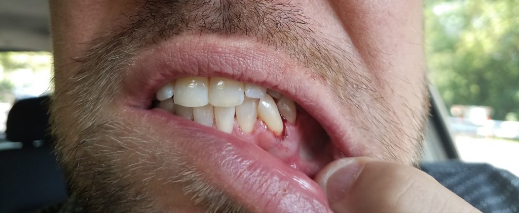 Mans mun där det blöder vid en tand.